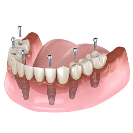 Illustration of an implant-supported bridge